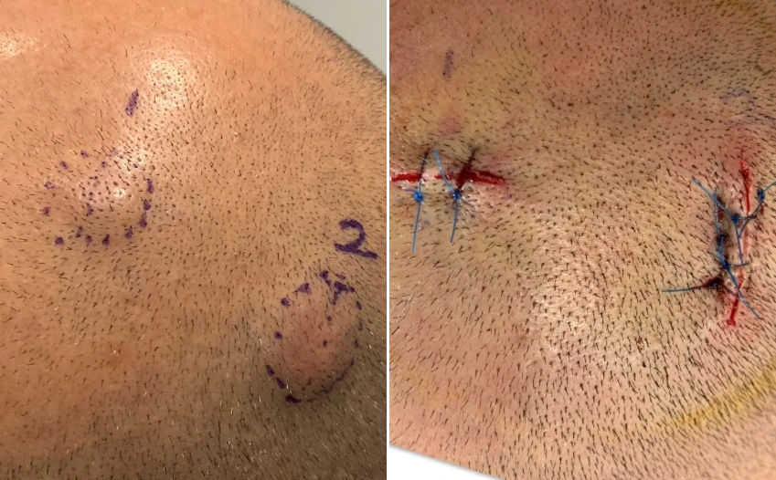 Minor Surgeries - Before & After 1