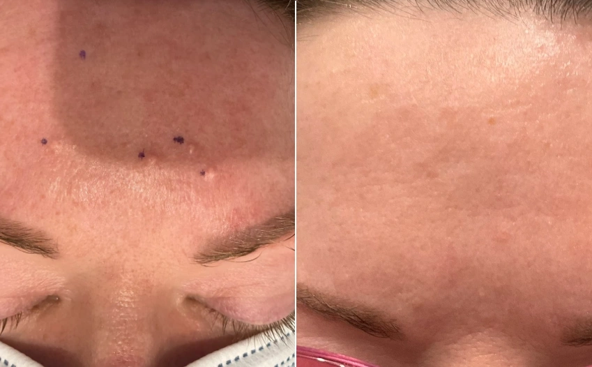 Sebaceous Hyperplasia - RF Removal